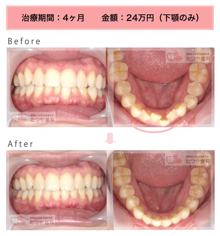 部分矯正の症例　下の前歯だけ