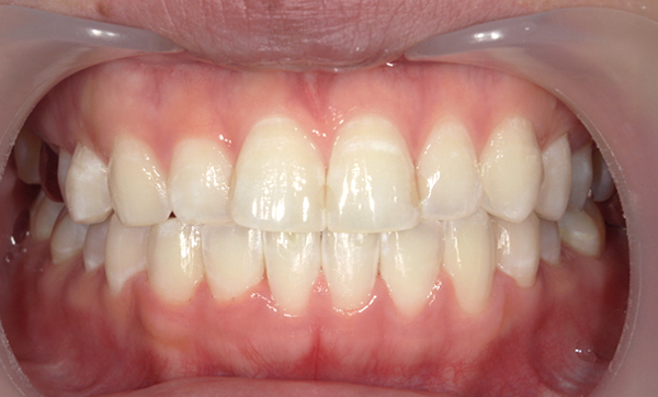 部分矯正 下の部分矯正の症例写真