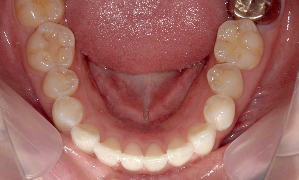部分矯正 下の部分矯正の症例写真
