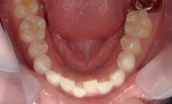 部分矯正 下の部分矯正の症例写真