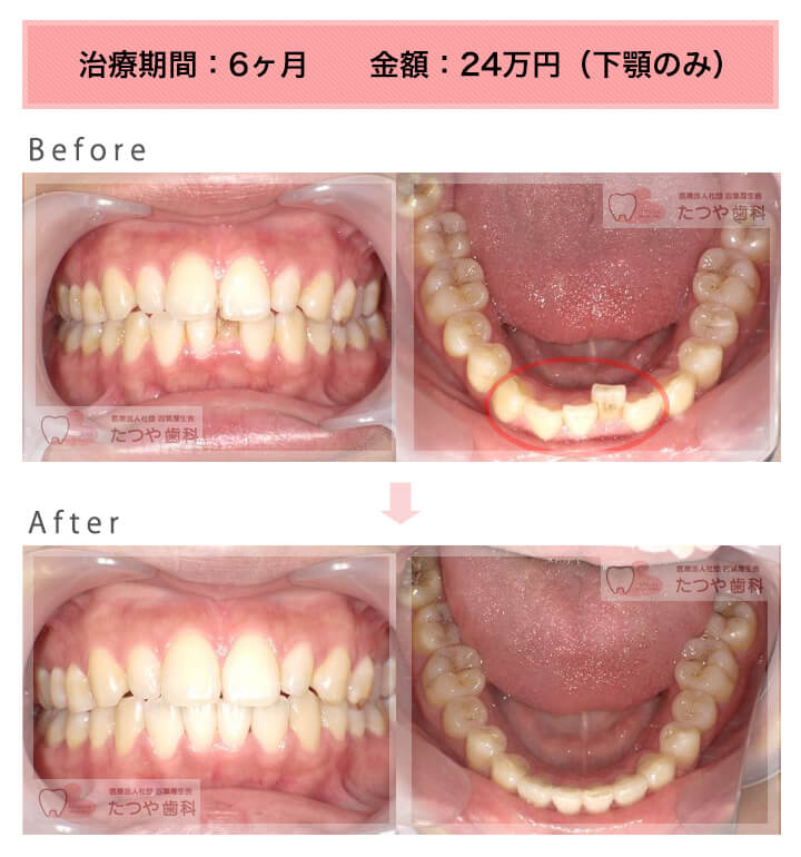 部分矯正の症例　下の前歯だけ