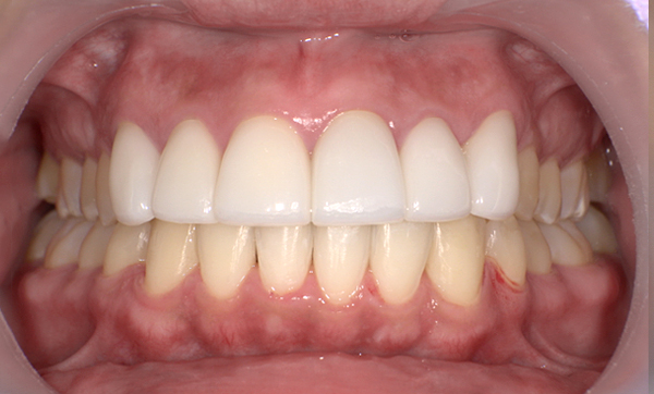 部分矯正 下の部分矯正の症例写真