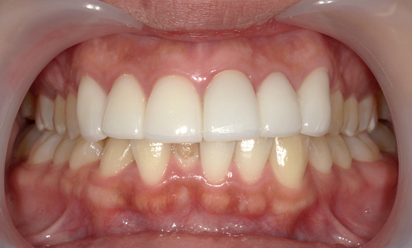 部分矯正 下の部分矯正の症例写真