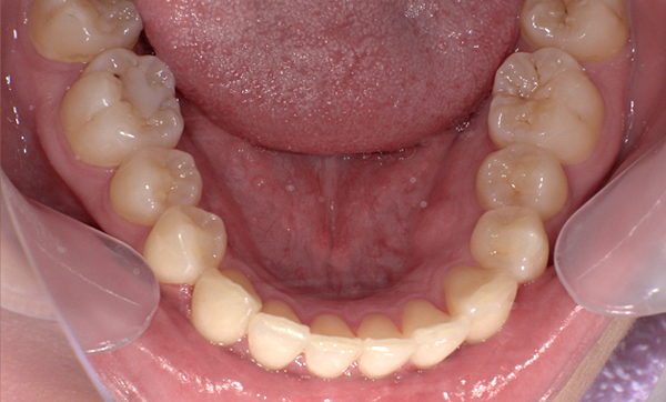 部分矯正 下の部分矯正の症例写真