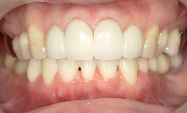 部分矯正 下の部分矯正の症例写真