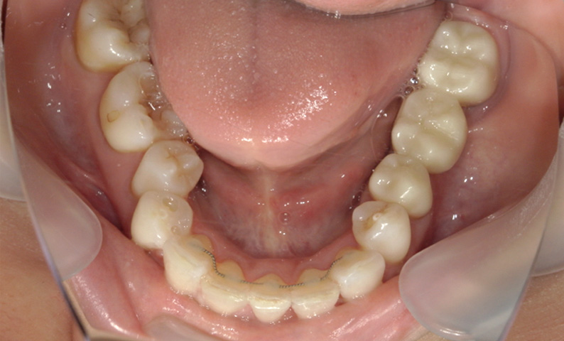 部分矯正 下の部分矯正の症例写真