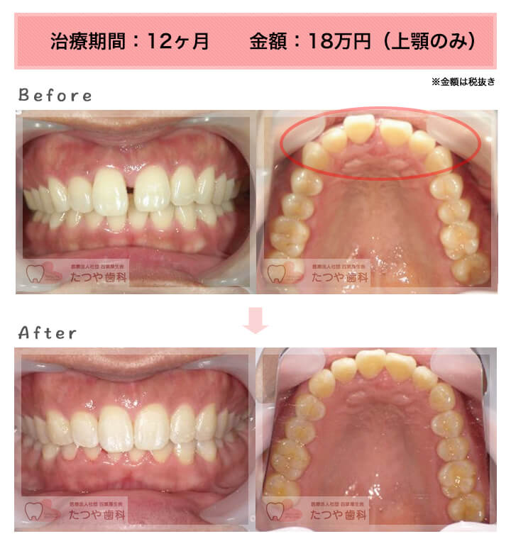 部分矯正の症例　前歯のすきっ歯
