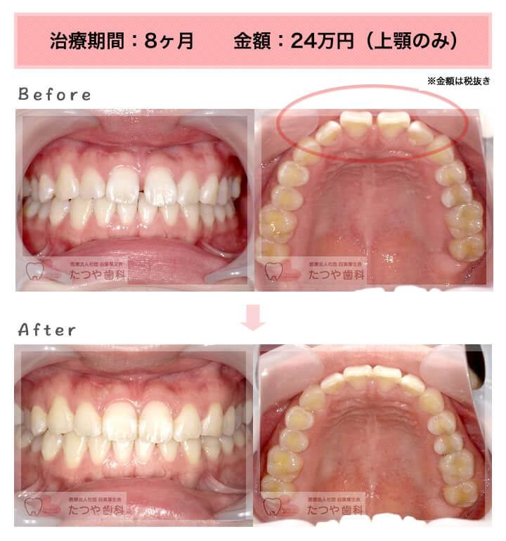 部分矯正の症例　前歯のすきっ歯