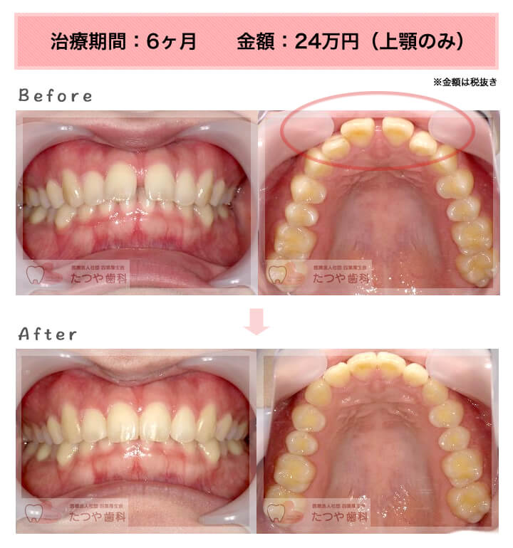 部分矯正の症例　前歯のすきっ歯