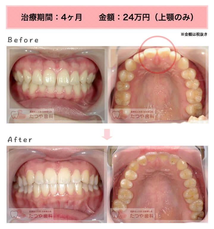 部分矯正の症例　前歯のすきっ歯