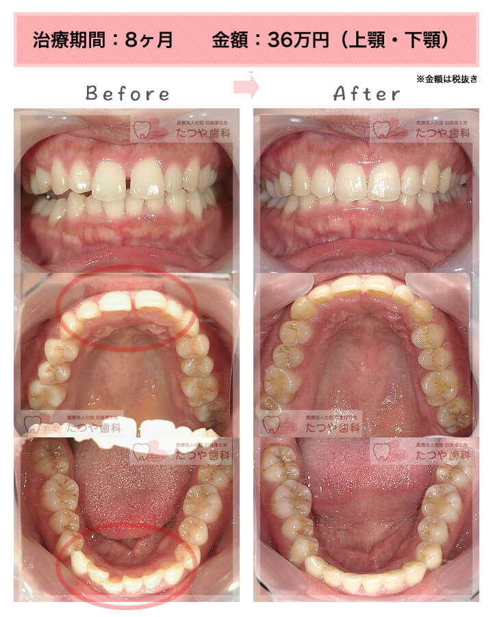 部分矯正の症例　前歯のすきっ歯
