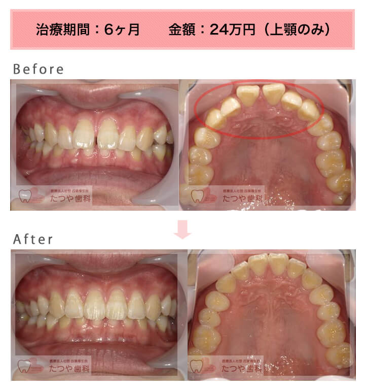 部分矯正の症例　前歯のすきっ歯