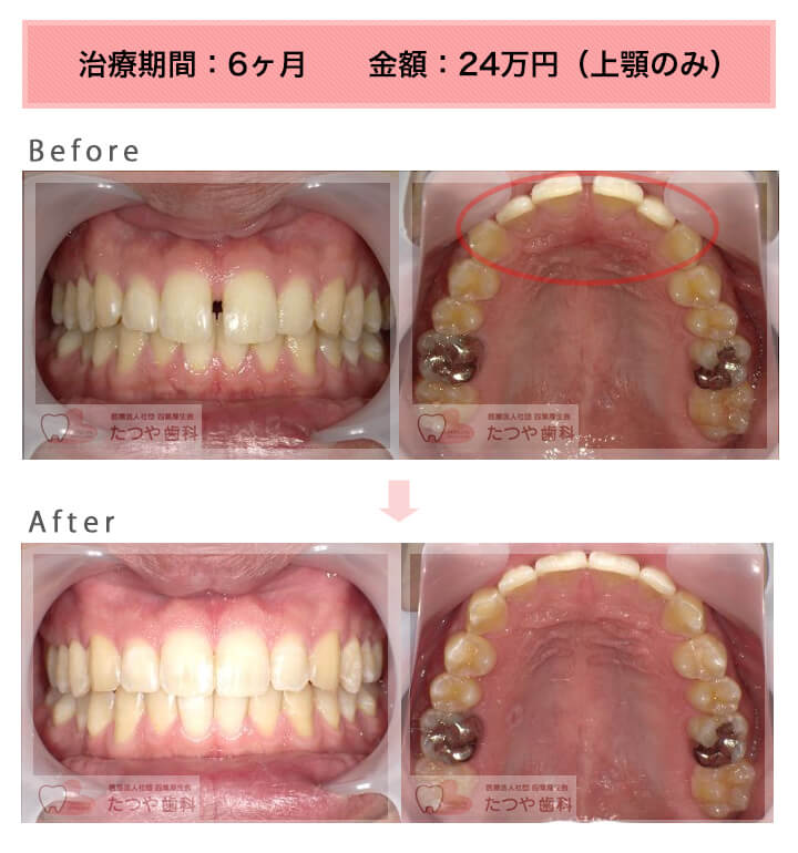 部分矯正の症例　前歯のすきっ歯