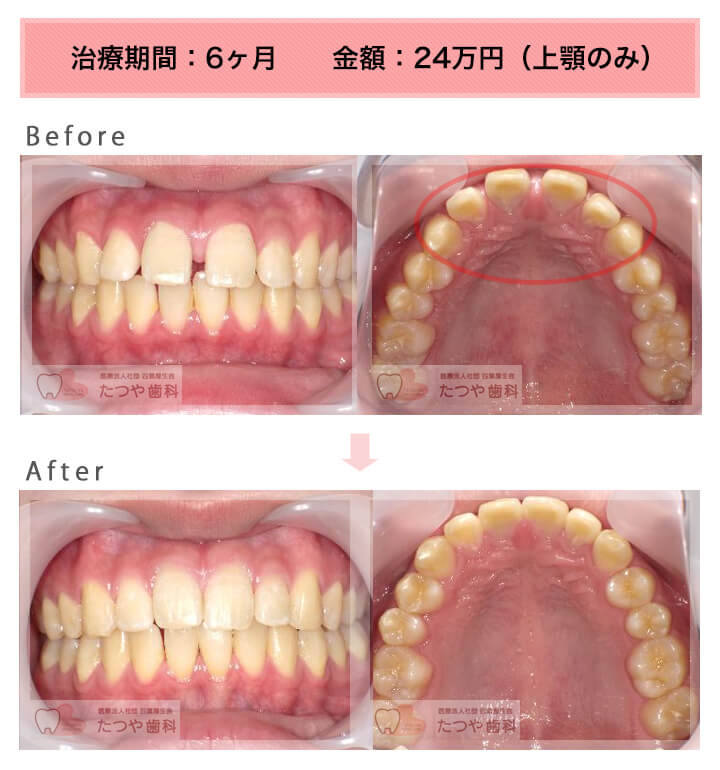 部分矯正の症例　前歯のすきっ歯