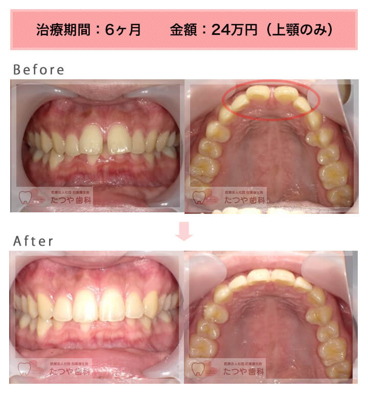 部分矯正の症例　前歯のすきっ歯