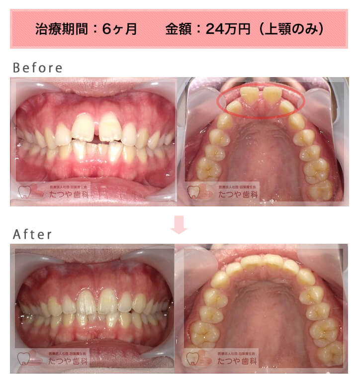 部分矯正の症例　前歯のすきっ歯