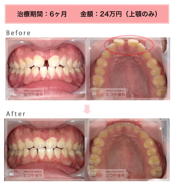 部分矯正の症例　前歯のすきっ歯