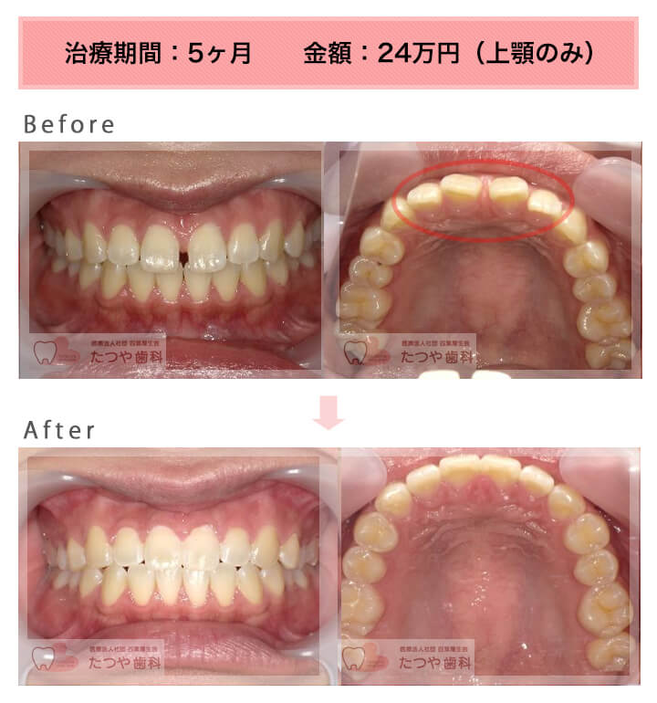 部分矯正の症例　前歯のすきっ歯