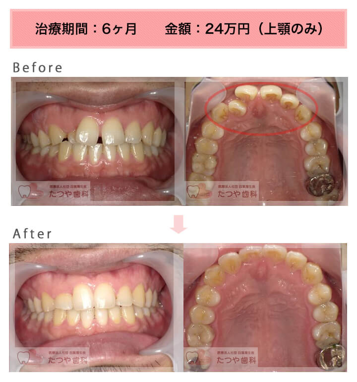 部分矯正の症例　前歯のすきっ歯