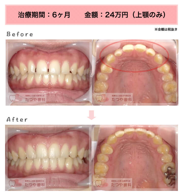 部分矯正の症例　前歯のすきっ歯