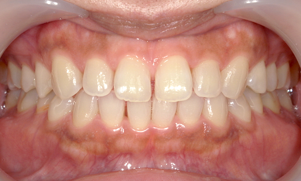 部分矯正すきっ歯の症例写真