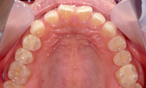 部分矯正すきっ歯の症例写真