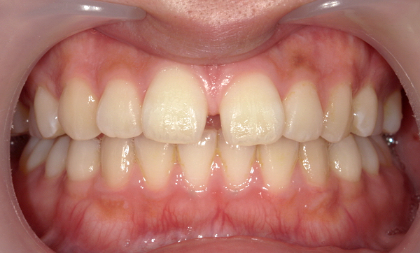 部分矯正 すきっ歯の症例写真