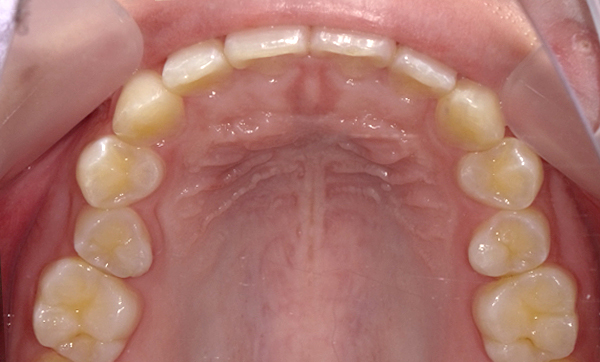 部分矯正 すきっ歯の症例写真