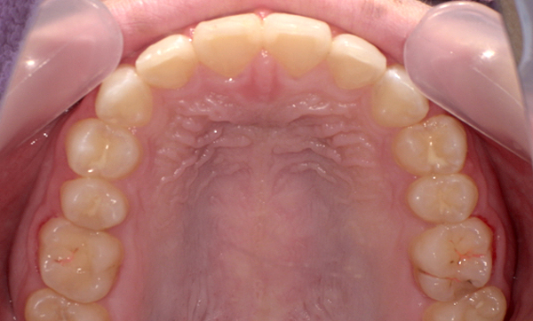 部分矯正 すきっ歯の症例写真