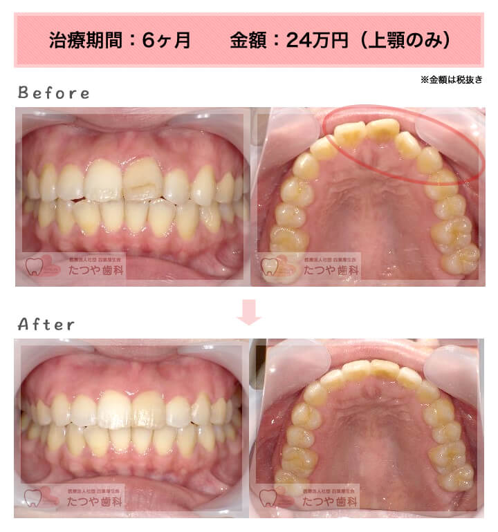 部分矯正の症例 上の前歯だけ