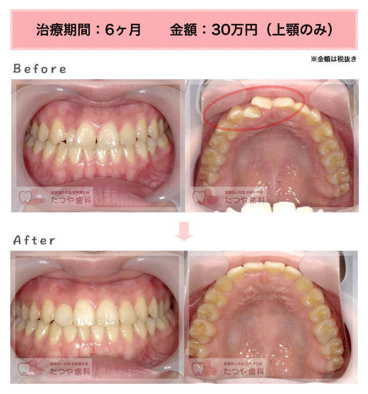 部分矯正の症例 上の前歯だけ