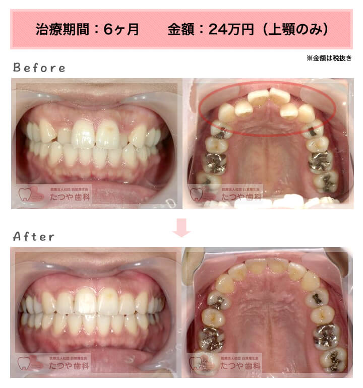 部分矯正の症例 上の前歯だけ
