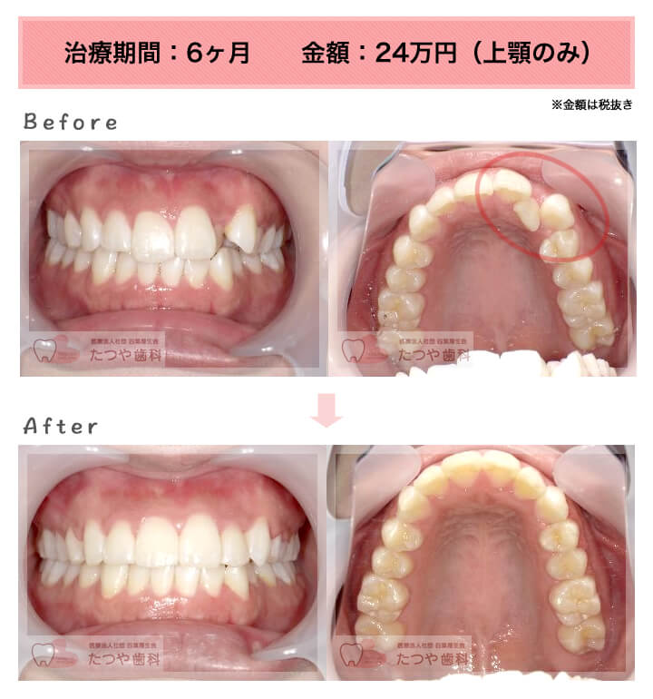 部分矯正の症例 上の前歯だけ