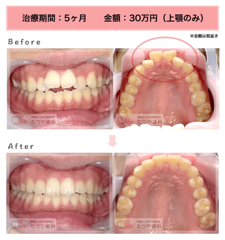 部分矯正の症例 上の前歯だけ