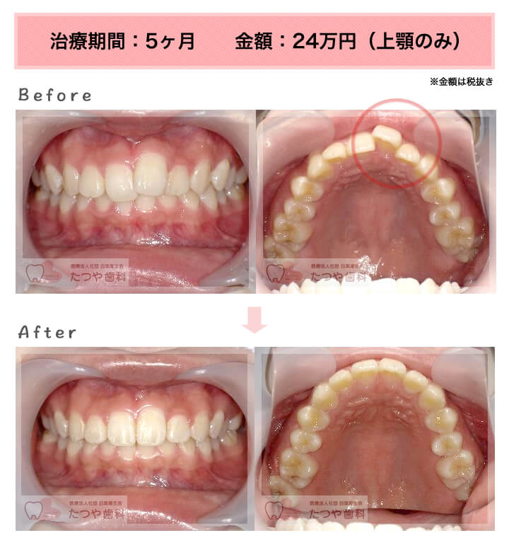 部分矯正の症例　上の前歯だけ