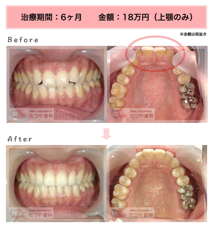 部分矯正の症例 上の前歯だけ