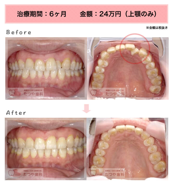 部分矯正の症例 上の前歯だけ