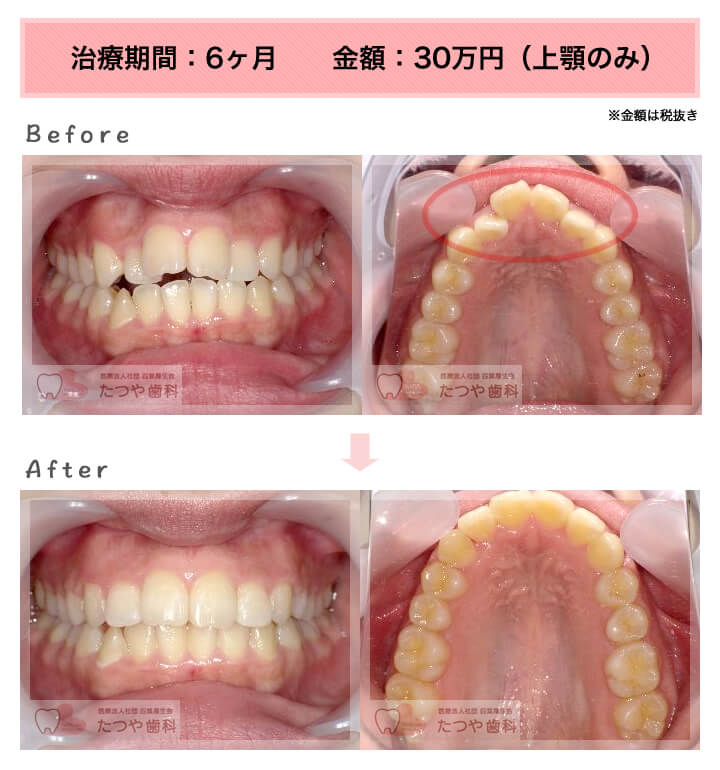 部分矯正の症例 上の前歯だけ