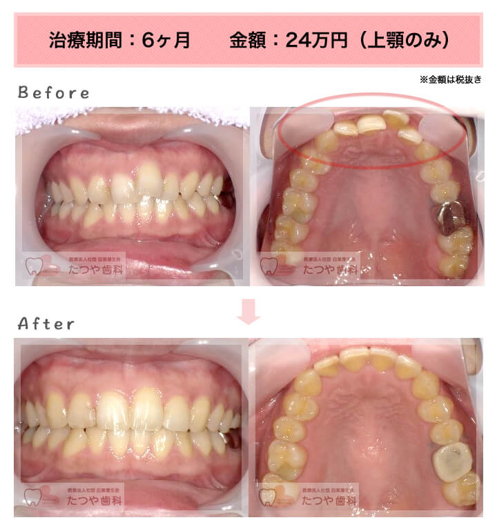 部分矯正の症例 上の前歯だけ