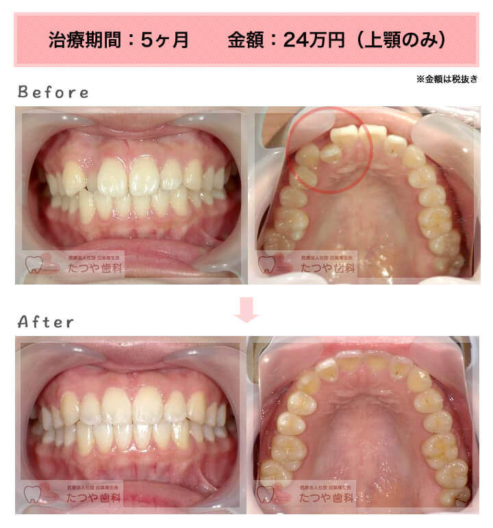 部分矯正の症例 上の前歯だけ