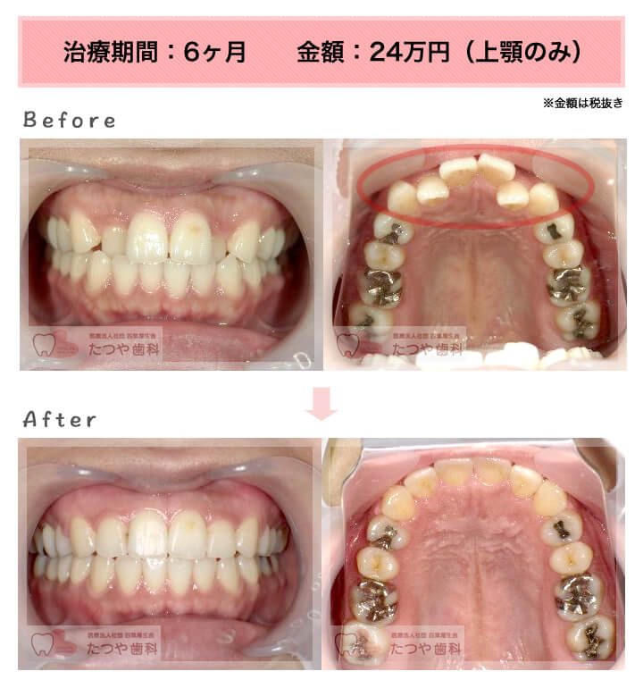部分矯正の症例 上の前歯だけ