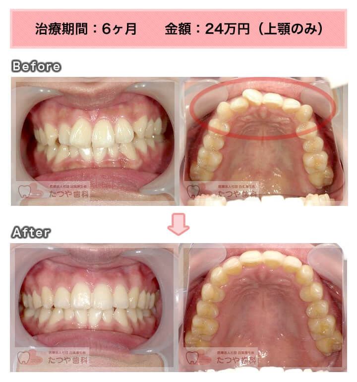 部分矯正の症例　上の前歯だけ