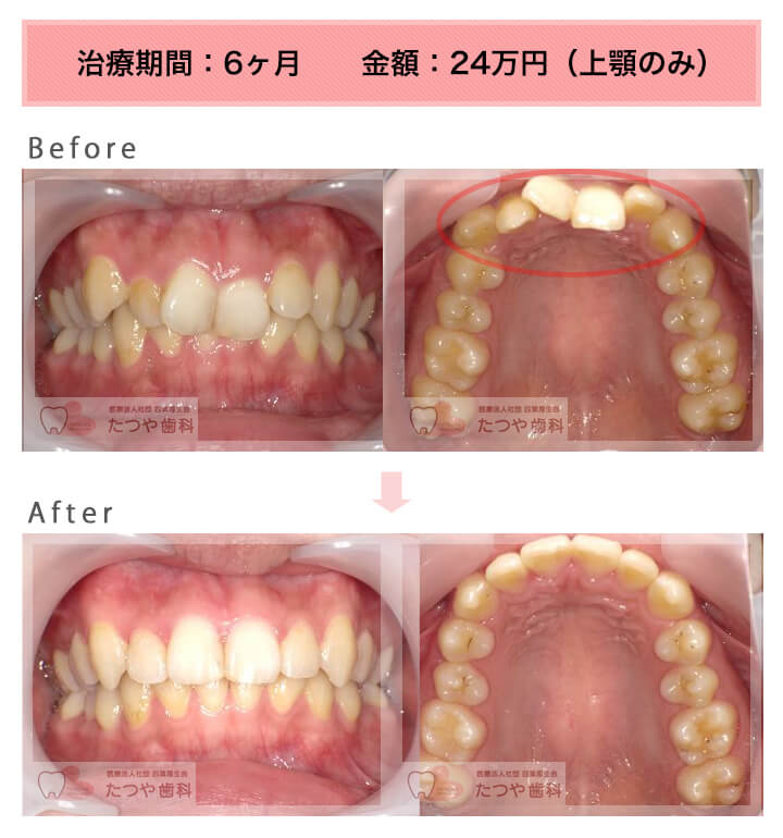 部分矯正の症例 上の前歯だけ