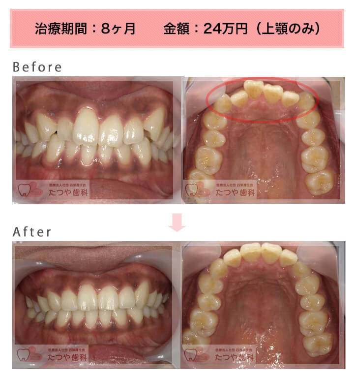 部分矯正の症例 上の前歯だけ