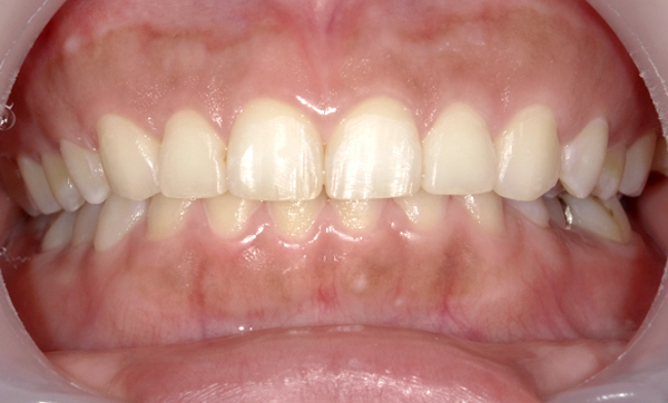 部分矯正 上の部分矯正の症例写真