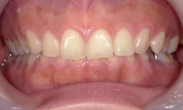 部分矯正 上の部分矯正の症例写真