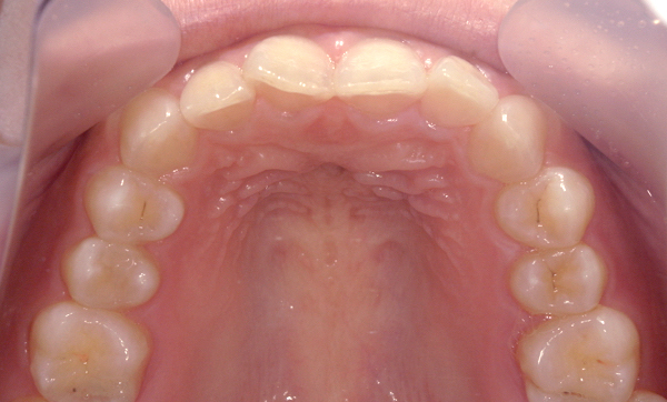 部分矯正 上の部分矯正の症例写真