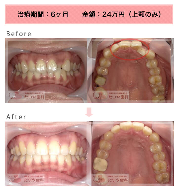 部分矯正の症例 上の前歯だけ