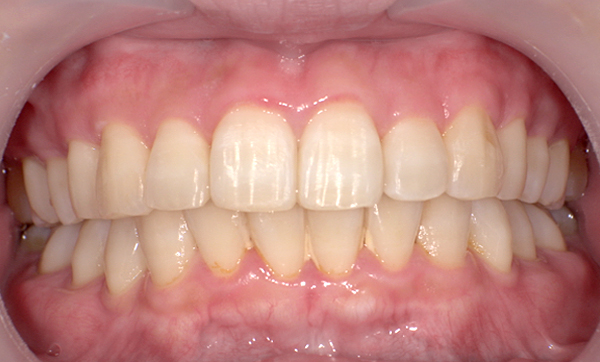 部分矯正 上の部分矯正の症例写真