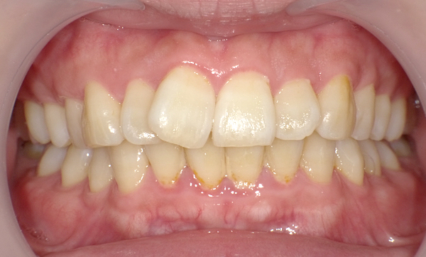 部分矯正 上の部分矯正の症例写真